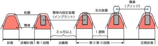 愛媛県西条市 東予歯科 インプラント治療概要図
